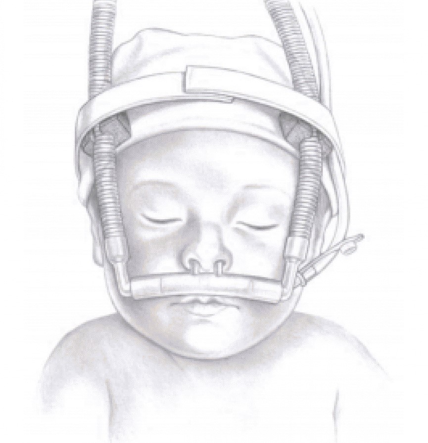 20221025-0702-5915-CPAP-INFANTIL-COM-CANULA-NASAL-EM-SILICONE-N--00-811.jpg