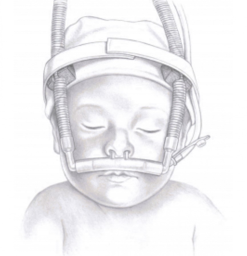 20221025-0702-5919-CPAP-INFANTIL-COM-CANULA-NASAL-EM-SILICONE-N--00-811.jpg